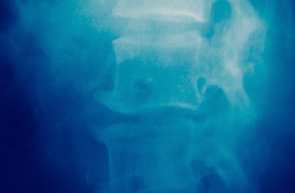 What is the treatment for lumbar disc herniation?