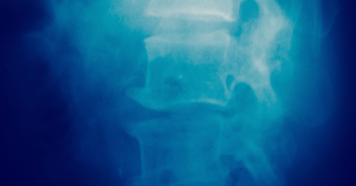 What is the treatment for lumbar disc herniation?